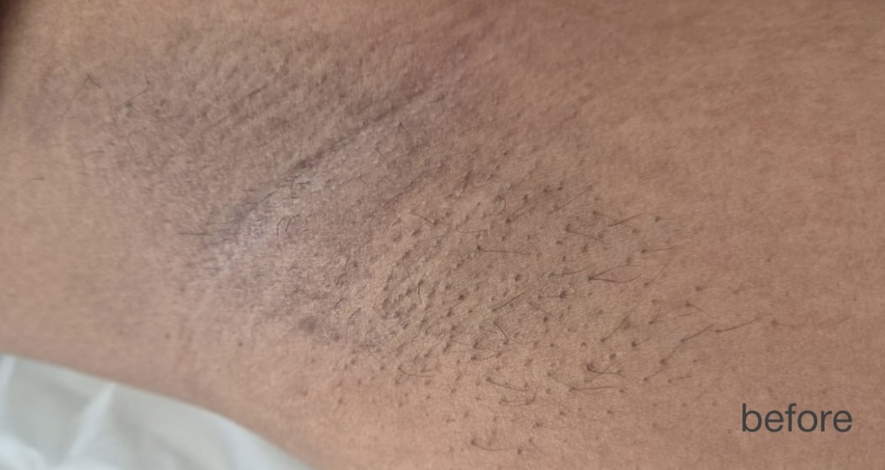 Before laser hair reduction